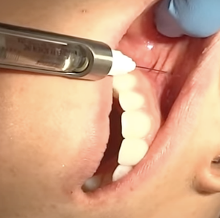 <ul><li><p>Mucobuccal fold between maxillary lateral and canine</p></li></ul><p></p>