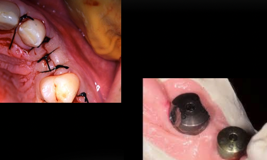 <p>How long is the healing phase after insertion of implant?</p>