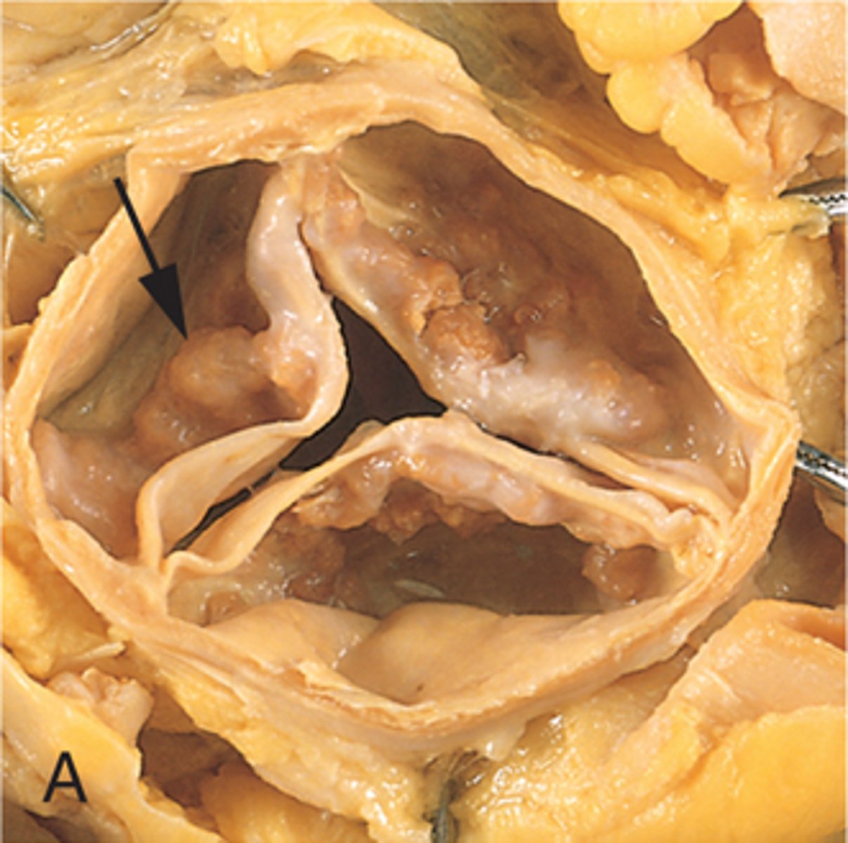 <p>stiffening and narrowing of heart valves; hard to pump through, heard as a murmur</p>