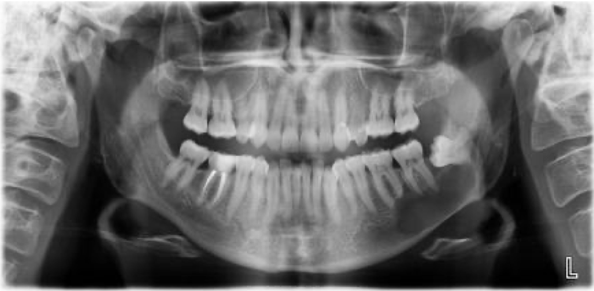 <p>A 19 year old patient present with mild swelling of lower jaw. Intra orally a small swelling was visible over left third molar region. A radiograph taken. Provide Differential diagnosis</p>