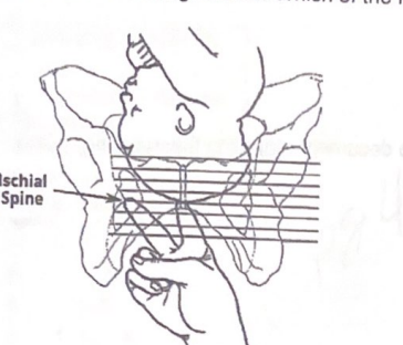 <p>The nurse has performed a vaginal exam on a client and notes that the fetal head is at the level indicated in the image below. What should the nurse document?</p><p></p>