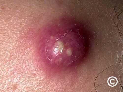 <ul><li><p>Boils caused by inflammation of hair follicles</p></li><li><p>Carbuncles are clusters of boils caused by bacteria infection</p></li></ul><p></p>