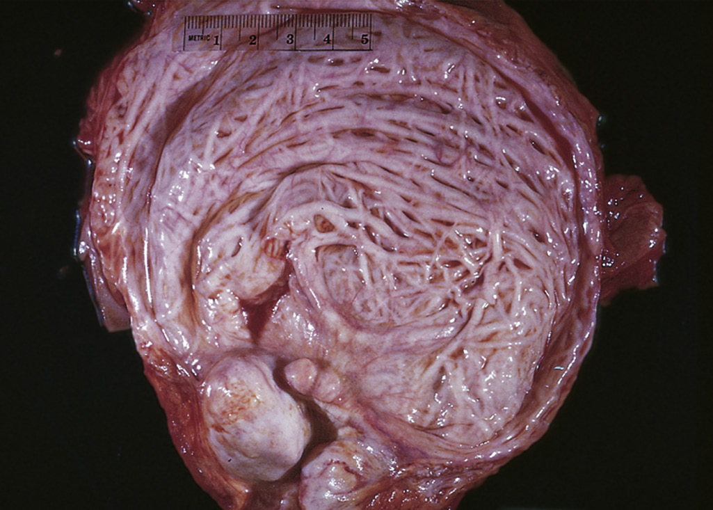 <p>\n A 78-year-old man has had increasing difficulties with urination for the past 6 years. He has difficulty starting and stopping the urine stream. On physical examination, his temperature is 37° C and blood pressure is 130/85 mm Hg. The figure shows the representative gross appearance of the bladder. Which of the following laboratory findings is most likely to be reported in this patient?</p>