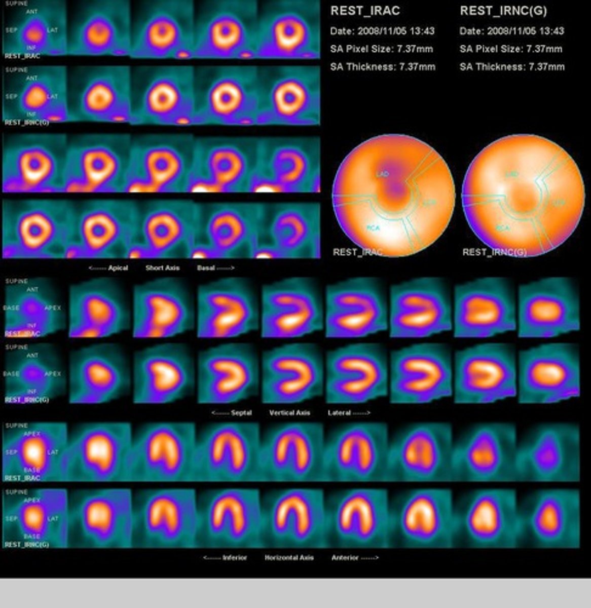 <p>It displays 3D perfusion information in a 2D format.</p>