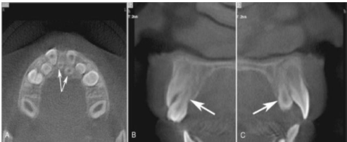 <p><span>Example of how CBCT is used to locate unerupted teeth in the maxillary arch.​</span></p>