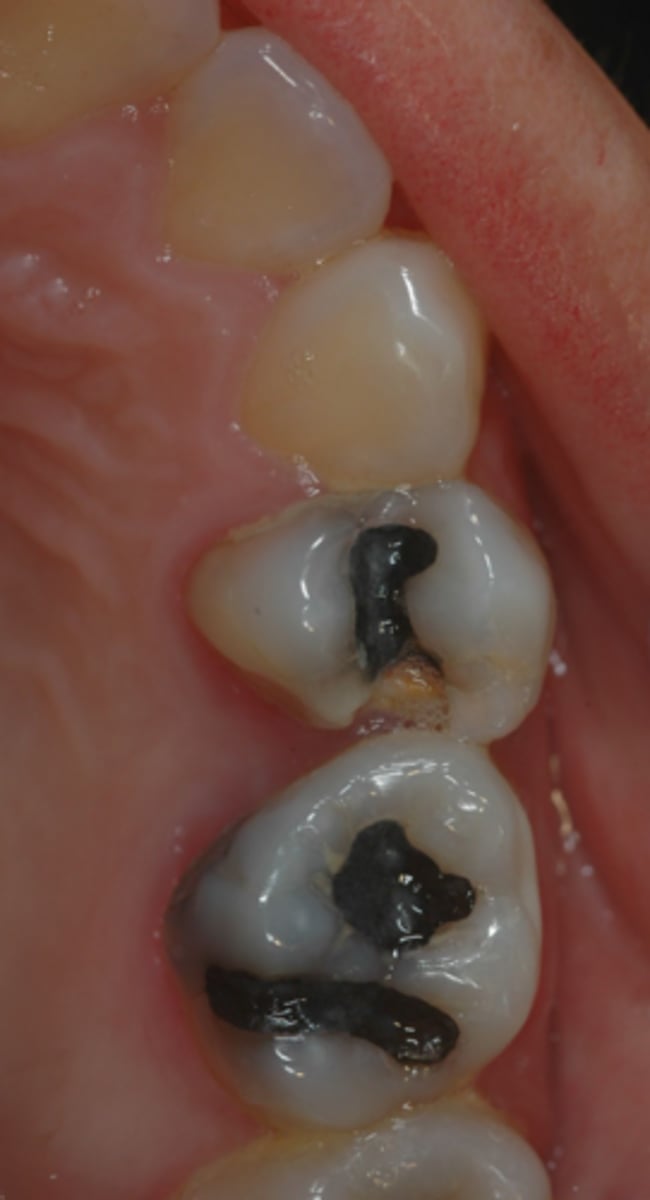 <p>Is #13 restorable or non-restorable?</p>