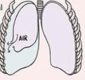 <p>air enters the pleura space without an outside wound </p><p>causes: </p><ul><li><p>traumatic impact (MVA) or </p></li><li><p>spontaneous rupture of lung tissue</p><ul><li><p>primary spontaneous: without history of lung diease </p></li><li><p>secondary: with history of lung disease </p></li></ul></li></ul><p></p>
