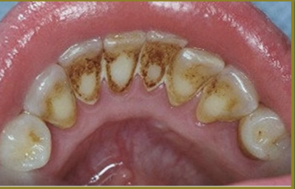 <p>Tobacco Stain:</p>