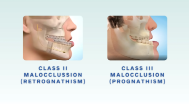 <p>Class 1 - maxilla and mandible are in normal relationship to each other → neutroclusion</p><p>Class 2 - the mand is retruded (distal relationship with maxilla) → retrognathic</p><p>Class 3 - The mand is protruded (mesial relationship with the max) → prognathic </p><p></p>