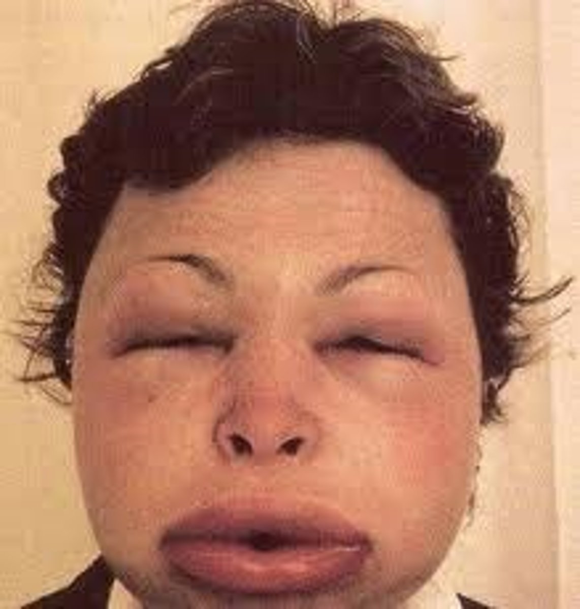 <p>Angioedema</p>