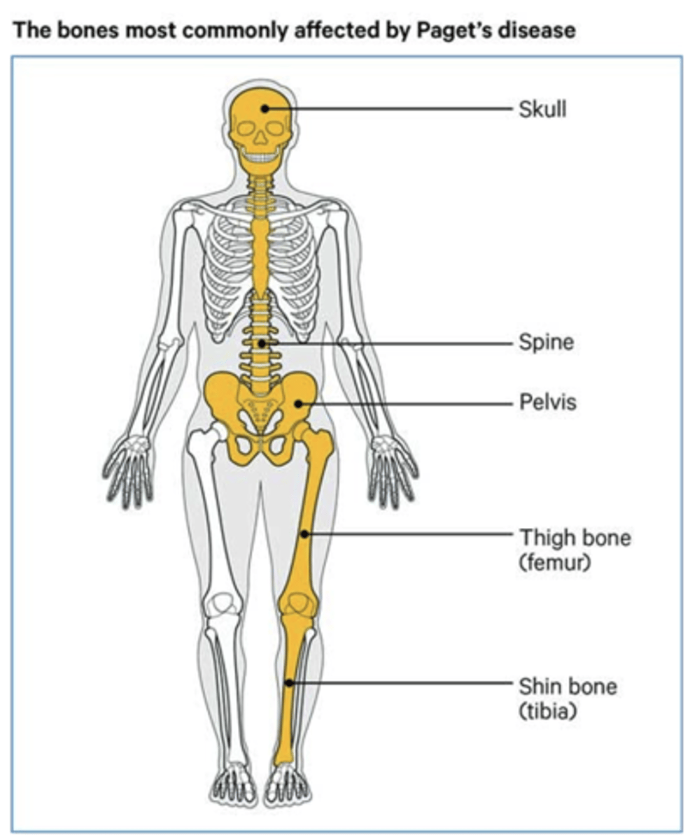 <p>Symptoms:</p><p>- Bone pain, abnormal bone curvatures, brain compression, impaired motor function, deafness, atrophy of the optic nerve</p><p>- Tumors and tumor like conditions</p><p>Treatment:</p><p>- Anti-inflammatory agents</p><p>- Bone resorption inhibitors</p><p>- Bisphosphonates</p><p>- Calcium/Vitamin D</p>