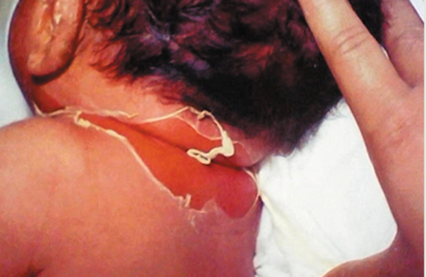 <p>scalded skin syndrome</p>