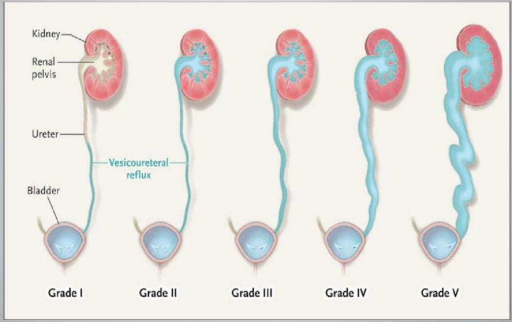 <p>VUR Grades</p><ul><li><p>Massive reflux grossly dilates the collecting system. All the calices are blunted w/ a loss of papillary impression, and intrarenal reflux may be present. There is significant ureteral dilation and tortuosity.</p></li></ul><p></p>