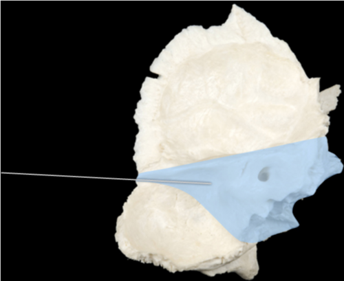 a pyramid-like and very solid part of the temporal bone
