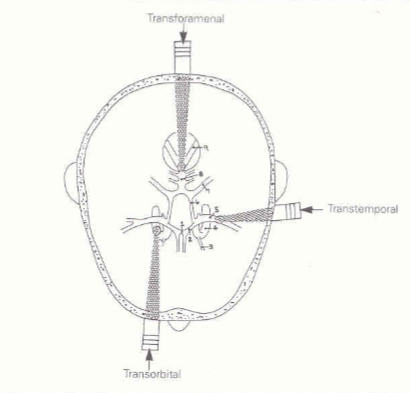 <p>Through eye </p>