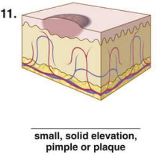 <p><span style="color: red">F Match each of the following lesions with their illustrations in Figure 16-26.</span></p><p></p>