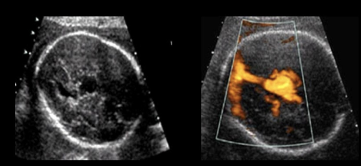 <p>while evaluating the fetal brain of 27w, you see an anechoic space midline in the cerebrum. the space appears to communicate w/an anechoic tubular structure coursing inferiorly. color doppler shows low velocity, swirling flow in the structures </p><p>a) vein of galen pseudoaneursym </p><p>b) aqueductal stenosis </p><p>c) dandy walker malformation</p><p>d) vein of galen aneurysm </p>