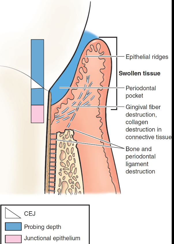 <p>permanent destruction</p><p>clinical: pink or purplish, swollen (edematous) or fibrotic, bleeding or pus, probing depths mm+</p><p>histological: JE on cementum (APICAL MIGRATION), supragingival fibers destruction (makes it easier for JE to migrate), alveolar bone destruction, periodontal ligament destruction</p>