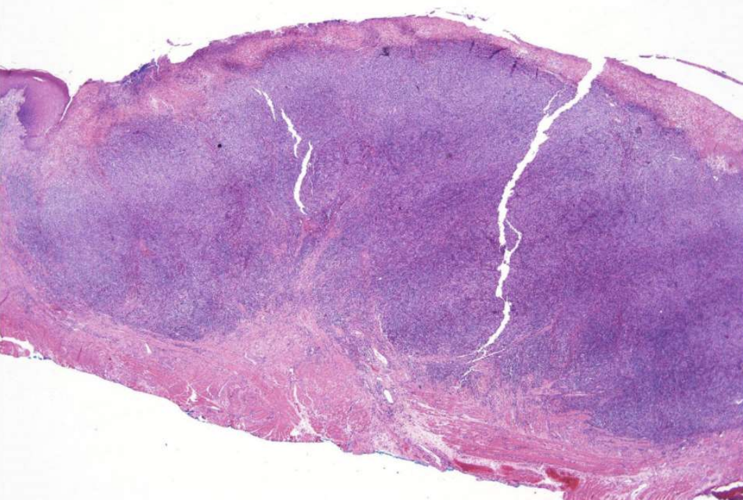 <p>what are histopathologic features of Traumatic Ulcerative Granuloma?</p>
