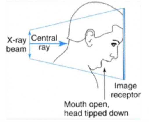 <p>To study coronal aspect of the mandibular condyles, rami, posterior wall of maxillary sinus, nasal septum, and styloid process. Useful in suspected fractures of the mandible. Shows medial displacement of the condyle.</p>