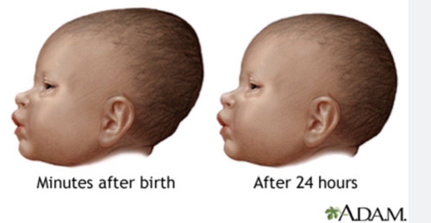 <p>ELONGATION of the newborn's head related to passage through the BIRTH CANAL and should resolve in the FIRST FEW DAYS OF LIFE.</p>