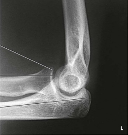 <p>What position would the hand be in for this radiograph?</p>