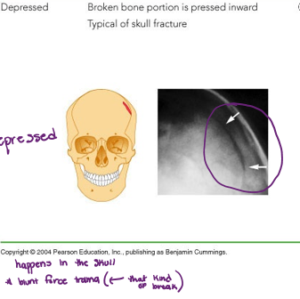 <ul><li><p>broken broke portion is pressed inward </p></li><li><p>typical fracture for the skull </p></li></ul>