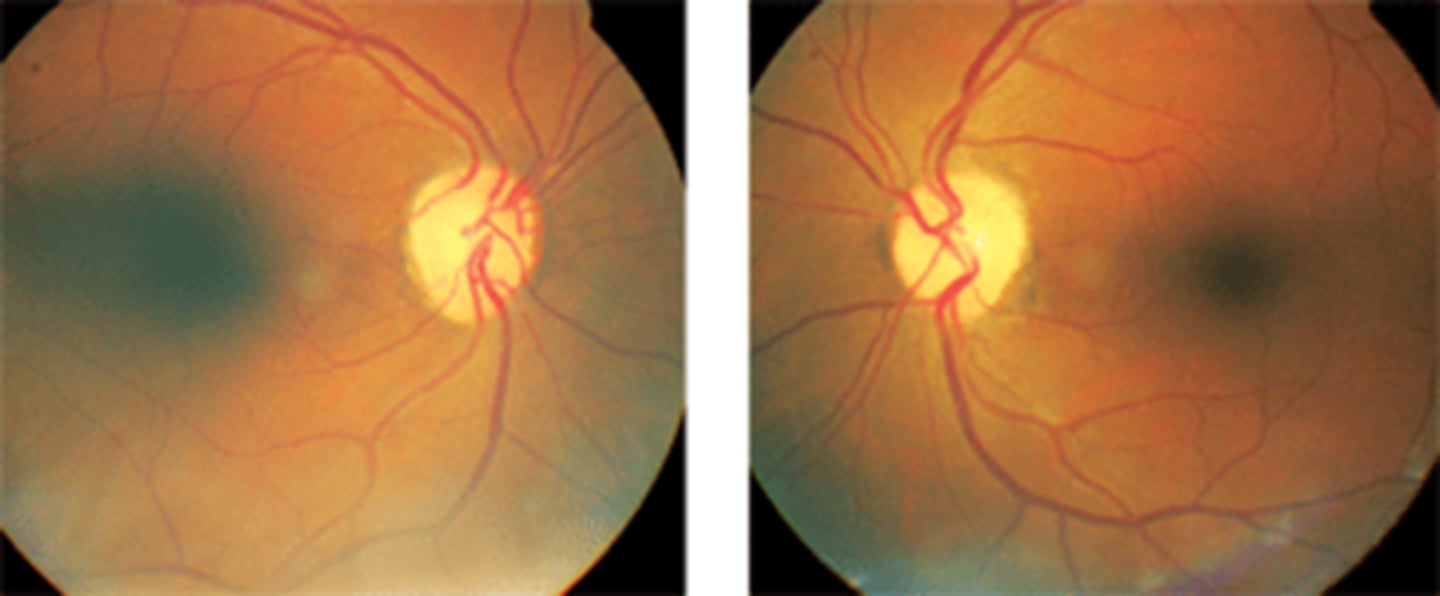 <p>difficult to ascertain cause = could be due to CRAO, canalicular meningioma, hypotensive events, etc.</p>