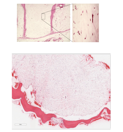 <p>Triangular, Stellate Cells in Loose Myxoid Stroma</p><p>idek wtf that pic is</p>