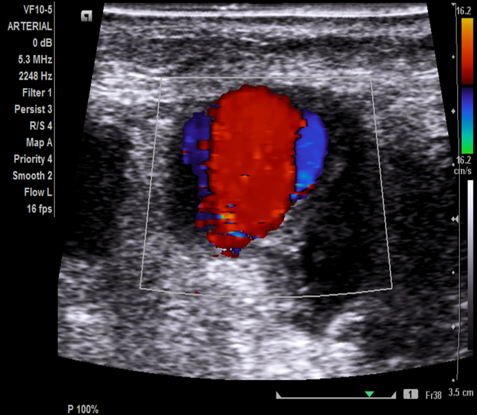 <p>Pt s/p RLE Fem-Pop graft x 4 years</p><p>Palpable, pulsatile mass area of proximal anastomosis. </p><p>You take this image in your arterial duplex imaging exam. </p><p>1.Where is proximal anastomosis and therefore palpable mass? </p><p>2.What possible findings are associated with aging grafts? </p><p>3.What is this likely finding in image? </p><p>4.What other steps will you take to document this finding? </p>