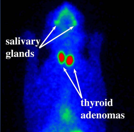 <p>describe the scintigraphy </p>