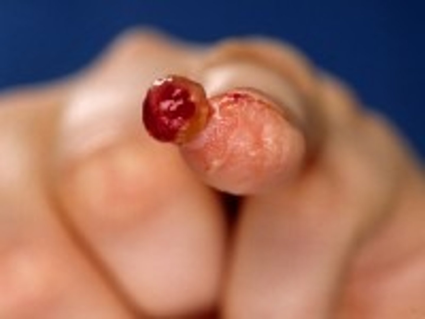 <p>= gesteelde, glanzend rode tumor die snel groeit en gemakkelijk bloedt. Omvat vooral het gelaat, de mond en de handen.</p>