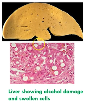 <ul><li><p>smooth endoplasmic reticulum damaged</p></li><li><p>fat metabolism stops, cytoplasm accumulates fat droplets - signet ring</p></li><li><p>nucleus pushed to the side - peripheral</p></li><li><p>reversible</p></li></ul><p></p>