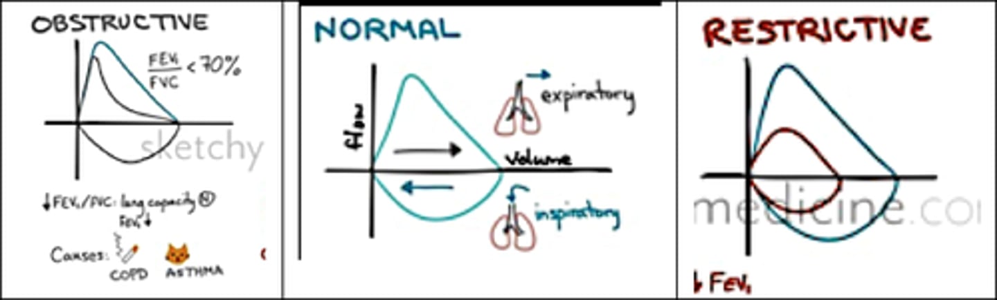 <p>Scooped-out appearance during expiration, seen in COPD, and asthma due to increased airway resistance.</p>