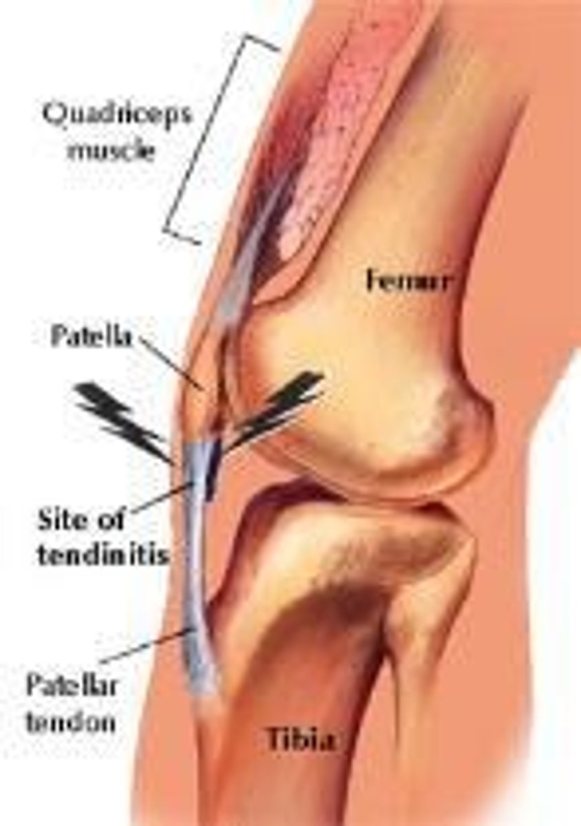 <p>Pain along the patellar tendon, typically under the patella or at the tibial tuberosity, often associated with quad weakness.</p>