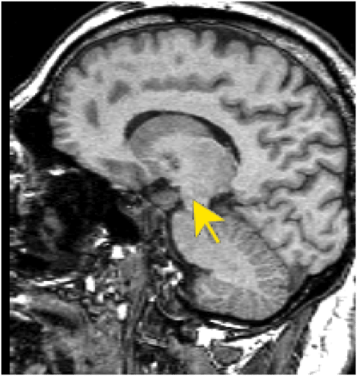 <p>Midbrain structure where dopamine is produced: associated with mood, reward, and addiction</p>
