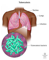 <p>most frequent site of infection for TB? What type of damage? pg. 789 in textbook</p>