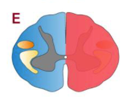 <p>Describe the effects of the lesion</p>