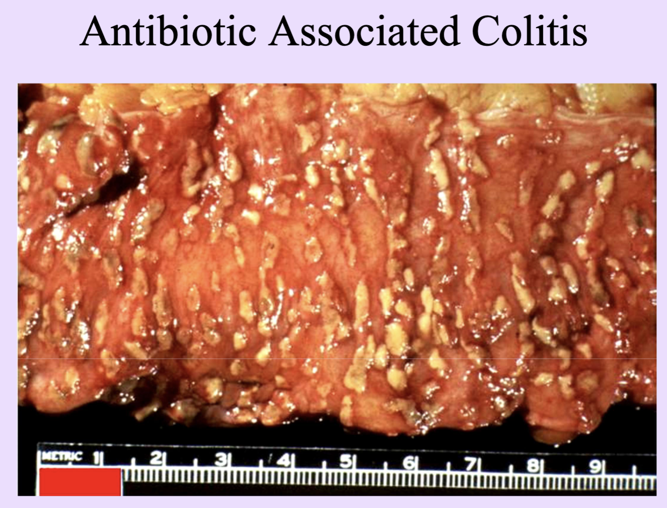 <ul><li><p>Form of ulcerative inflammation </p></li></ul><p>Inflammation with pseudomembrane formed by fibrinopurulent exudate (e.g., C. difficile colitis).</p>