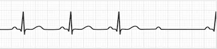 <p>constant PR intervals, QRS usually wide; occasional dropped QRS complexes</p>