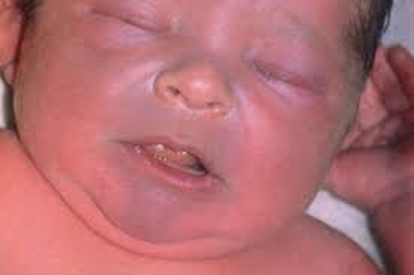 <p>cyanosis right after birth, does not improve with O2</p>