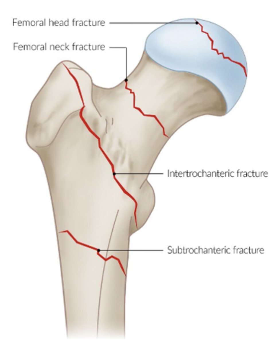 <p>high rates of morbidity and mortality<br>- femoral neck<br>- intertrochanteric<br>- trochanteric</p>