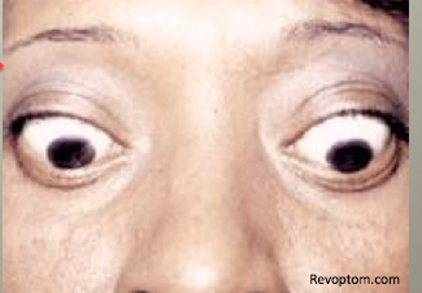 <p>- the eyelids stay open when a person looks down</p><p>- associated with hyperthyroidism</p>