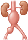 <p>What aneurysm shape is the following</p><ul><li><p>Bulging on all sides</p></li></ul><p></p>