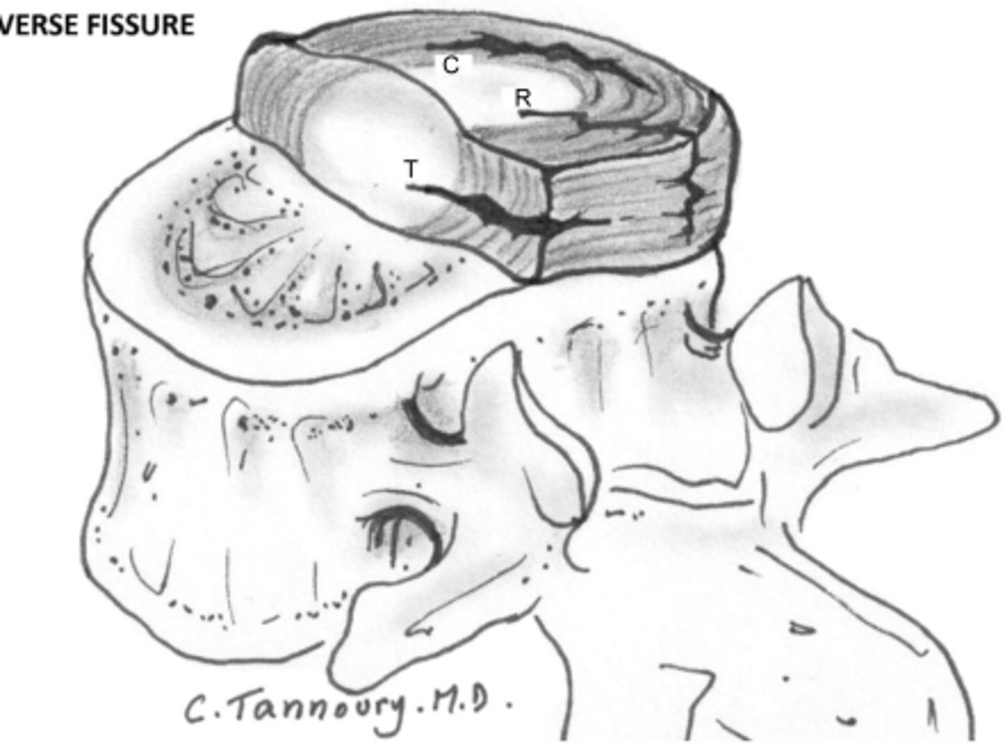 <p>35</p><p>- extent of fissuring varies according to age and disc level</p>