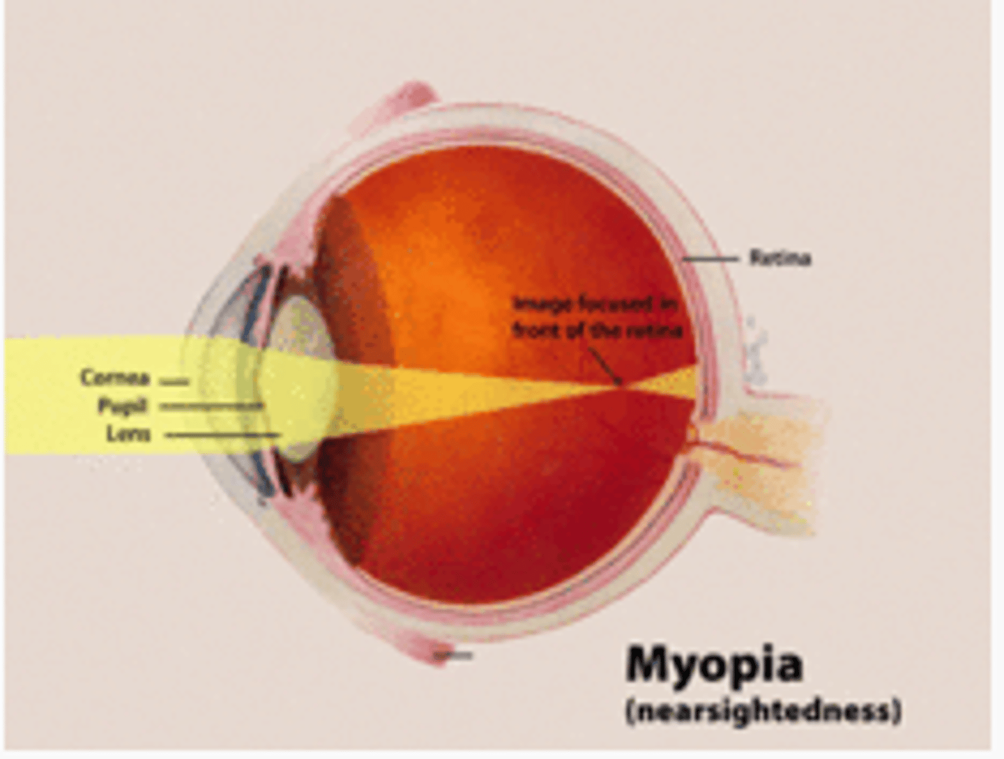 <p>Nearsightedness; can't see distance well.</p>