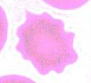 <p>“crenation”; are spiculated rbc’s</p><ul><li><p>projections may be sharp or blunt, usually numerous, and evenly spaced around the circumference</p></li><li><p>spicules are uniform in size</p></li></ul><p></p>