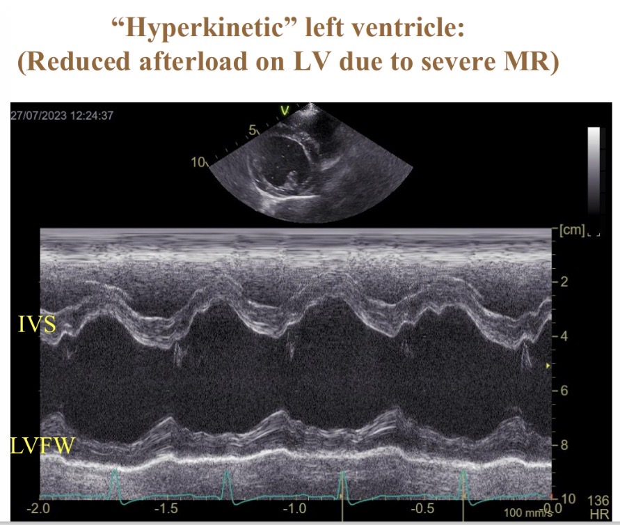<p>What is IVS (hyperkinetic in mitral valve disease)</p>