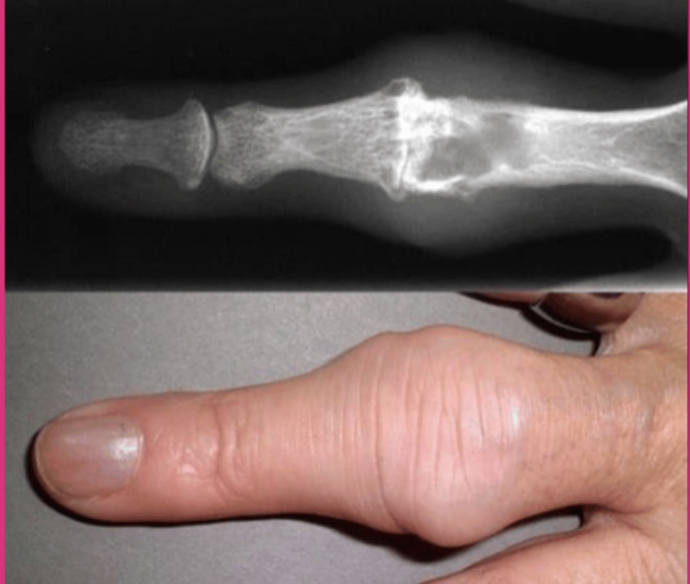 <p>abnormal stiffening and immobility of a joint due to the fusion of the bones</p><p>fusiform inflammation</p>