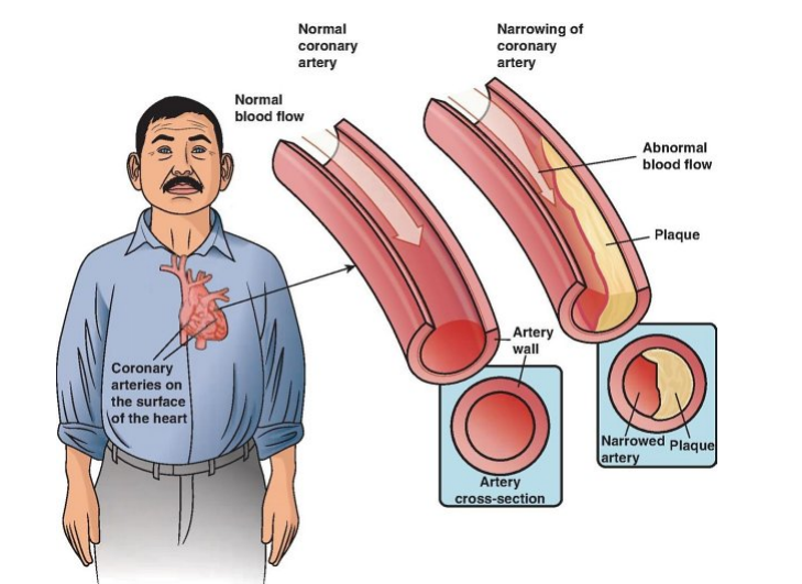 <p>About __% of men and women age 40–59 have heart disease.</p>